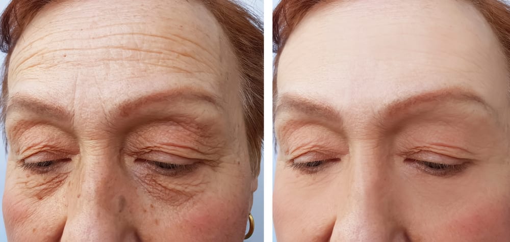 Sylfirm X vs Morpheus8 RF microneedling comparison in Westchester Los Angeles