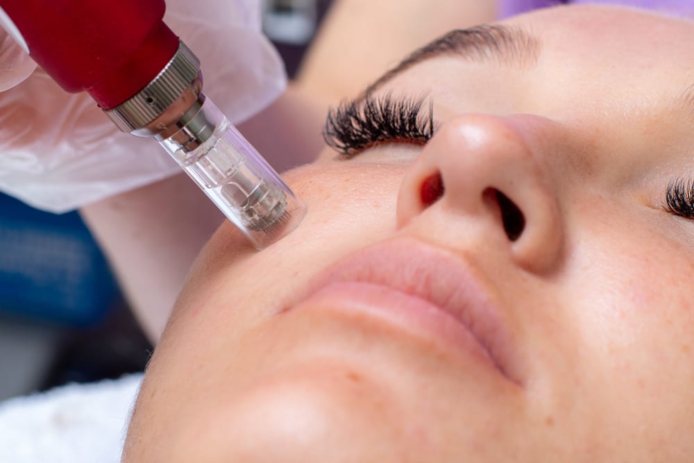 Microneedling skin rejuvenation treatment in Westchester Los Angeles