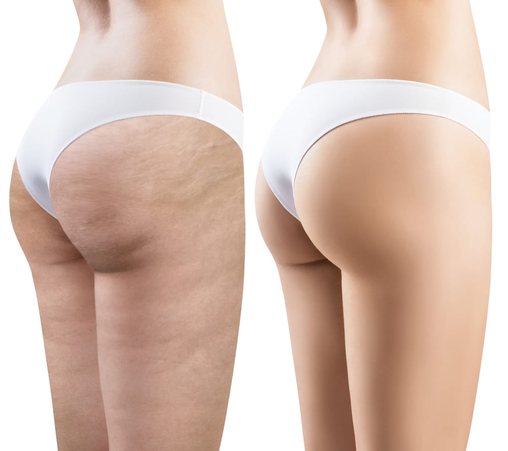 Emtone cellulite reduction treatment near Playa Vista Los Angeles