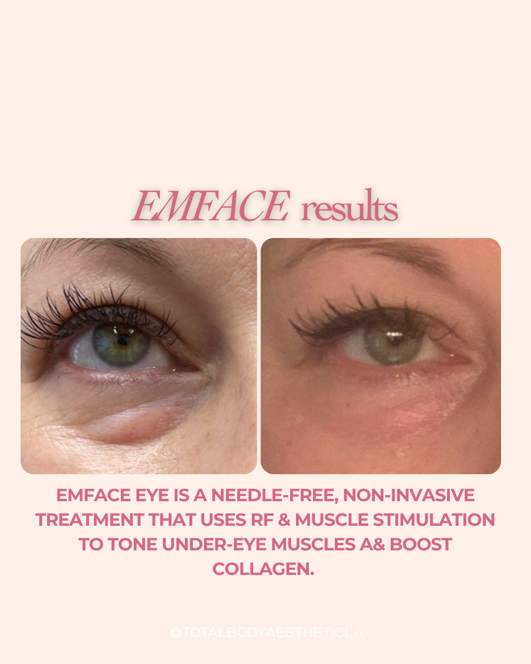 EMFACE Eye under-eye treatment before and after results needle-free RF muscle stimulation Total Body Aesthetic Westchester Los Angeles 90045