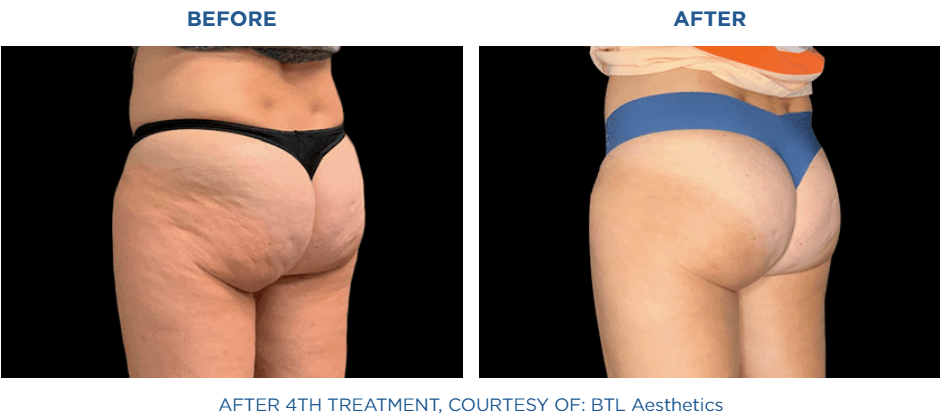 EMTONE cellulite reduction before and after 4 treatments on glutes and thighs near Playa Vista