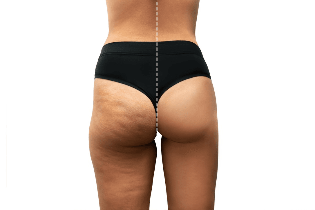 Before and after cellulite treatment showing smooth skin result Emtone Los Angeles Total Body Aesthetic
