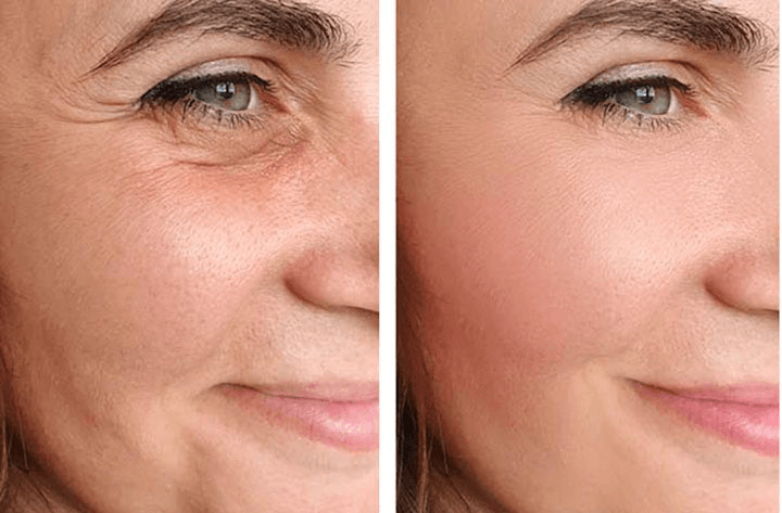 Before and after non-surgical facelift - smoother skin, reduced wrinkles, lifted face Total Body Aesthetic Los Angeles 90045