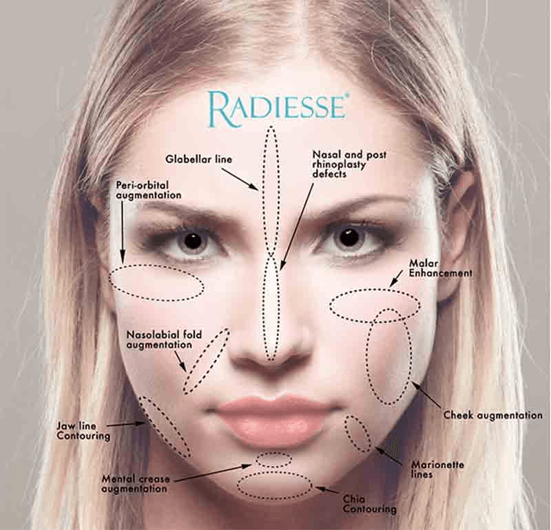 Radiesse filler treatment areas on the face — cheeks, jawline, nasolabial folds and chin — in Westchester Los Angeles