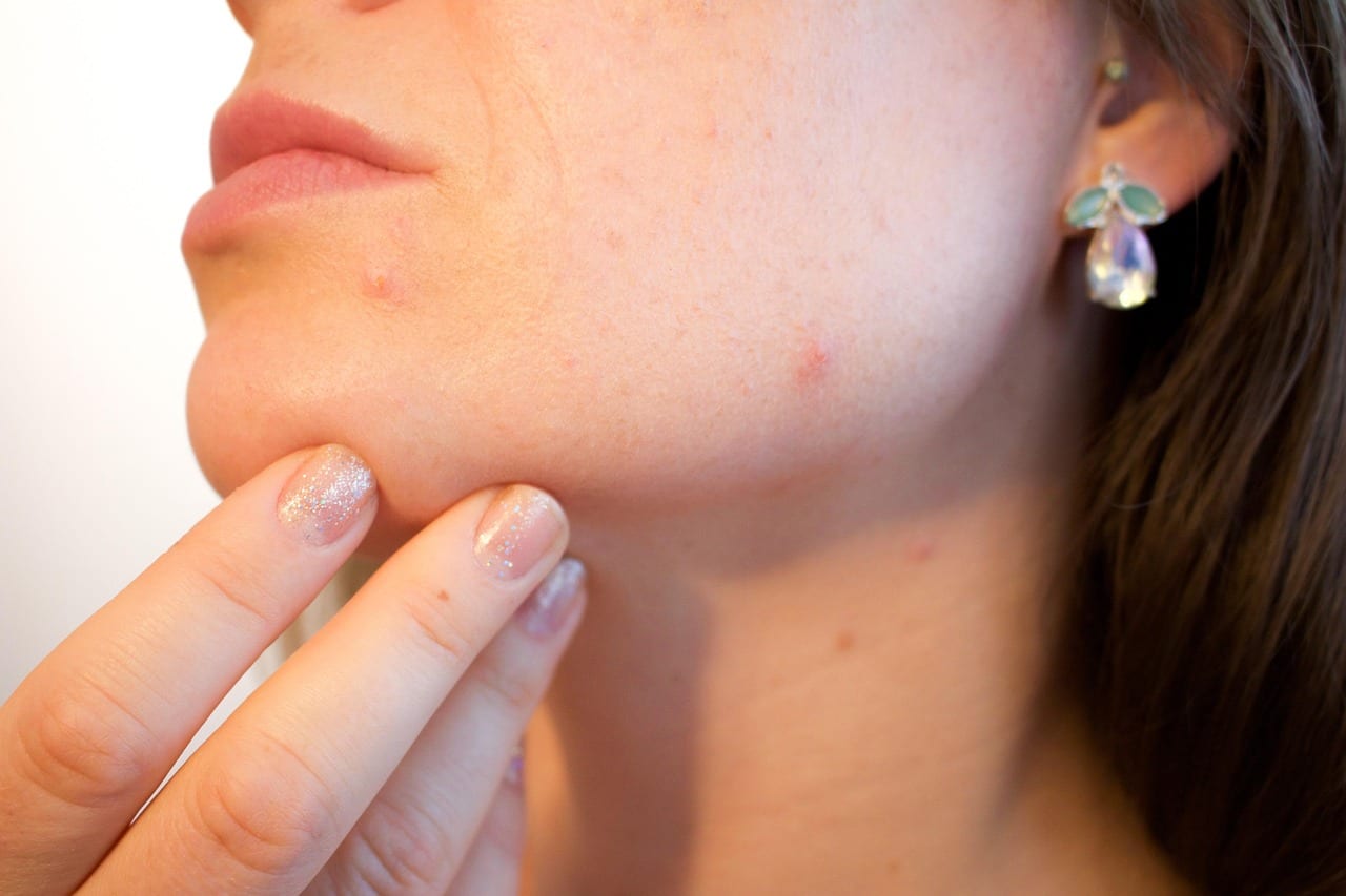 Treat acne and aging skin near El Segundo Los Angeles