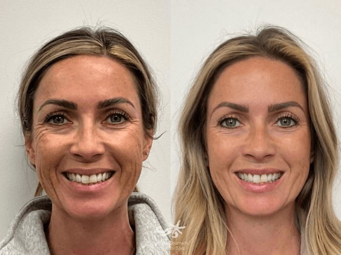 Botox before and after wrinkle reduction results in Westchester Los Angeles