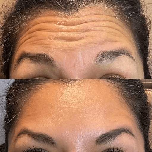 Botox forehead before and after results near Playa Vista