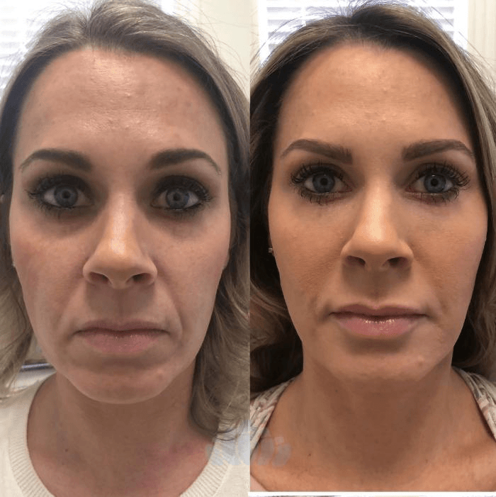 Botox before and after facial wrinkle results in Los Angeles 90045
