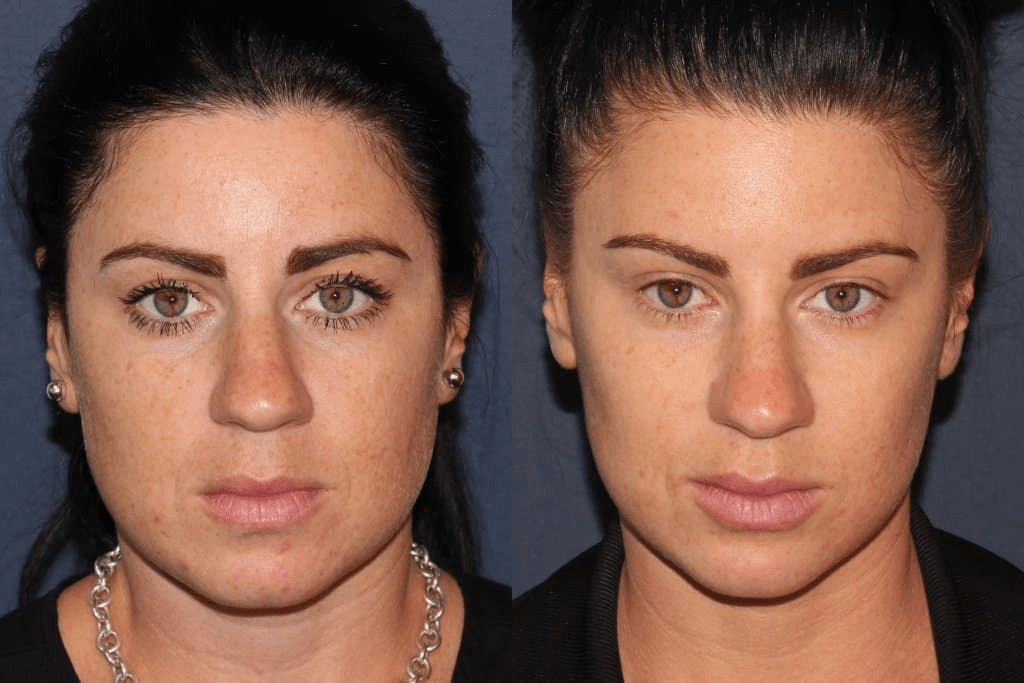 Botox before and after results near Marina del Rey