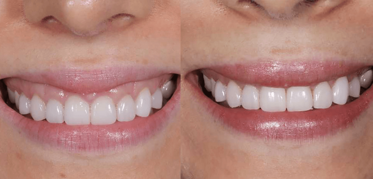 Botox lip flip before and after results at Total Body Aesthetic med spa Los Angeles