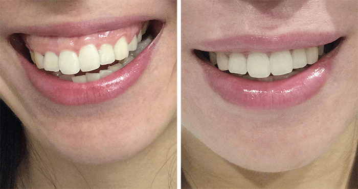 Botox lip flip before and after enhancement in Westchester Los Angeles