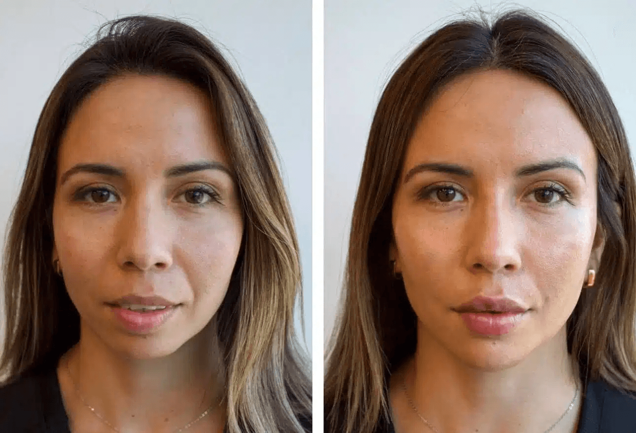 Dermal filler before and after results in Los Angeles 90045