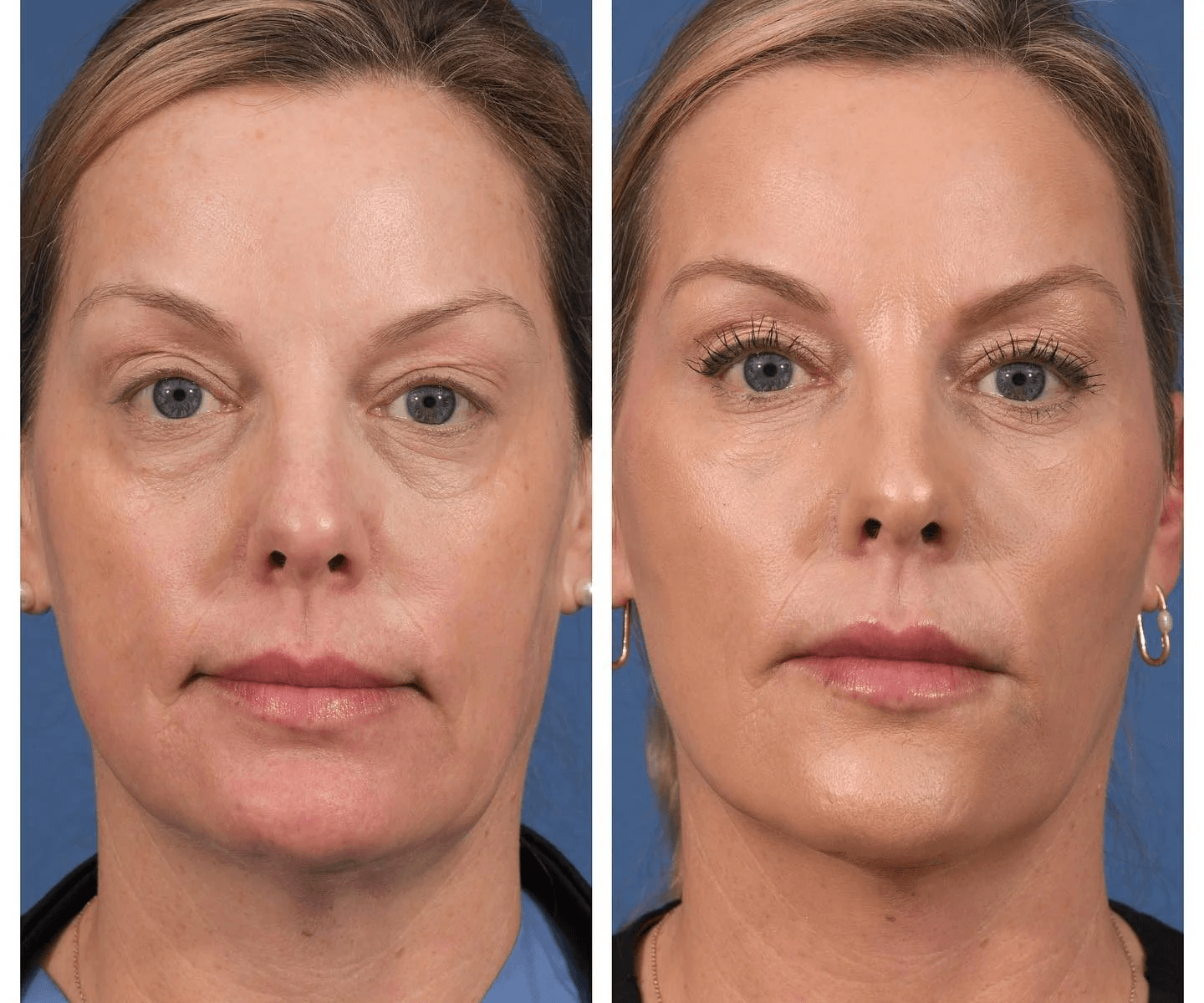 Dermal filler before and after cheek volume near Marina del Rey Los Angeles