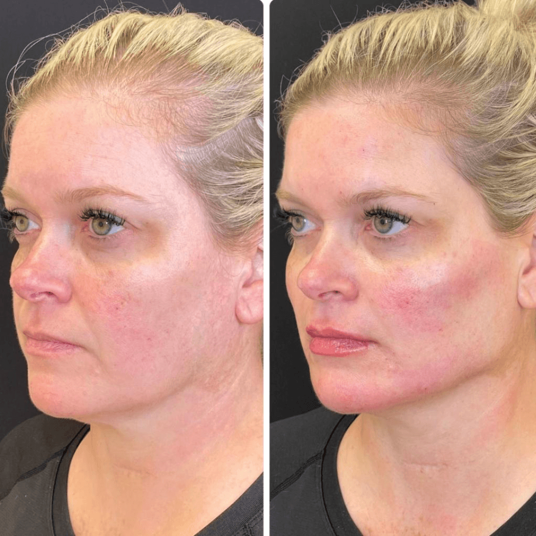 Dermal filler before and after lip enhancement in Westchester Los Angeles