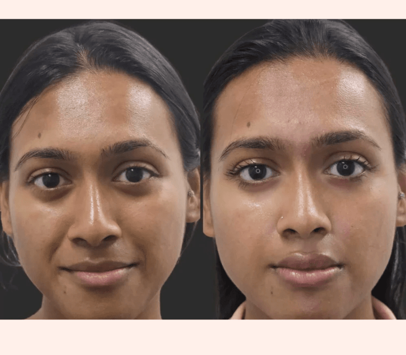 Dermal filler before and after results near Playa Vista Los Angeles