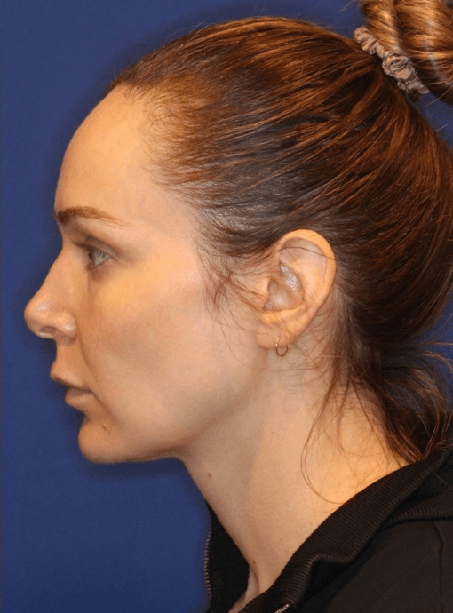 After Emface facial treatment near Playa Vista Los Angeles
