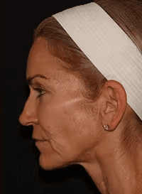 After Emface facial treatment in Los Angeles 90045