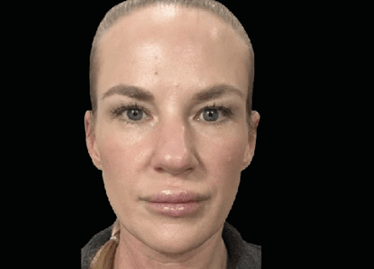 After Emface facial treatment near Marina del Rey Los Angeles
