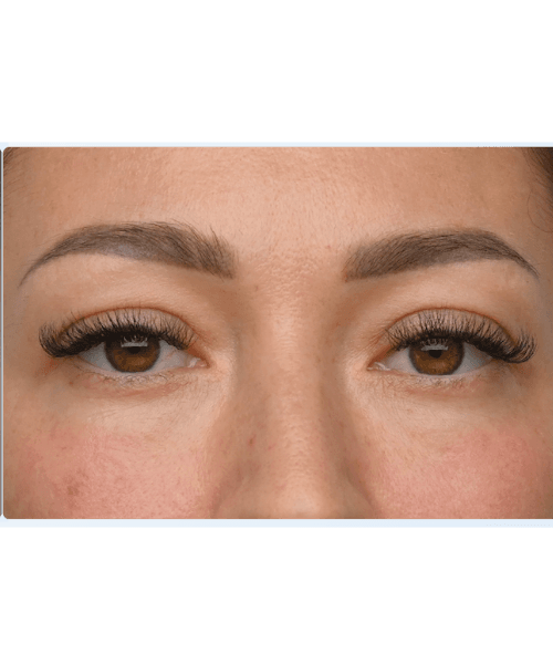 After Emface facial treatment at Total Body Aesthetic med spa Los Angeles