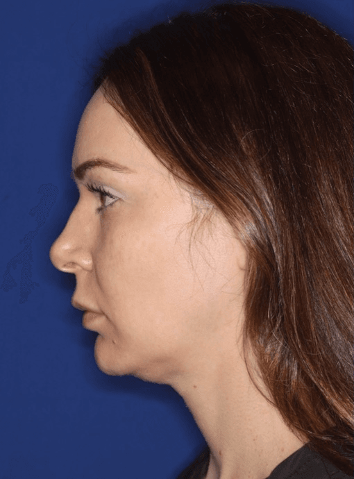 Before Emface facial treatment near Playa Vista Los Angeles