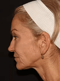 Before Emface facial treatment in Los Angeles 90045