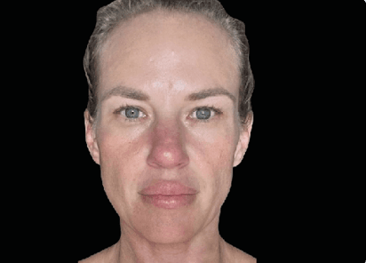 Before Emface facial treatment near Marina del Rey Los Angeles
