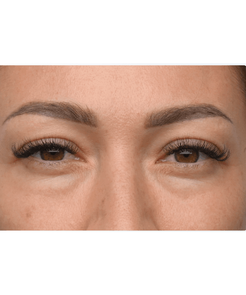 Before Emface facial treatment at Total Body Aesthetic med spa Los Angeles