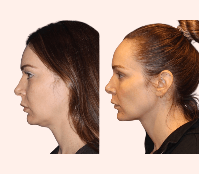 Emface Submentum before and after jawline profile in Los Angeles 90045