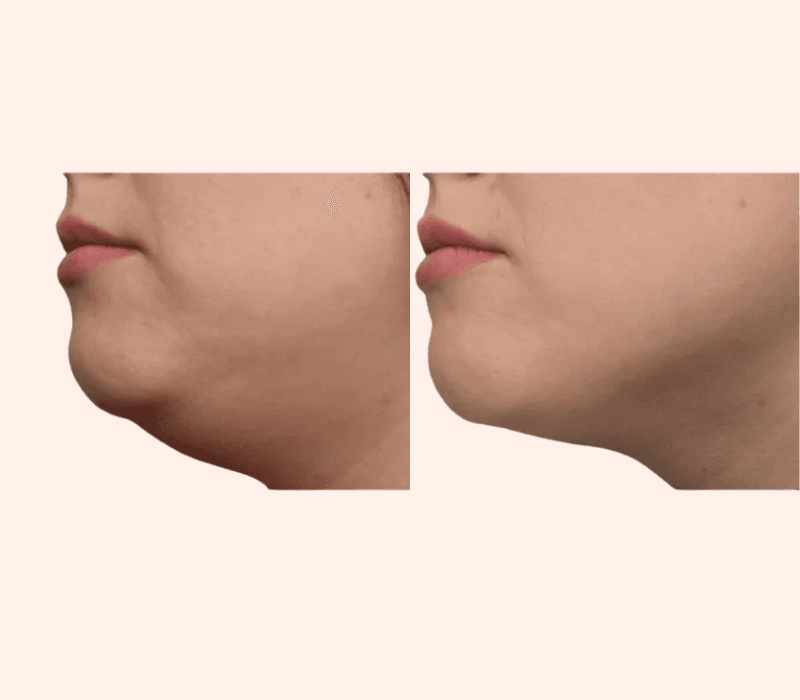 Emface Submentum before and after chin reduction near Marina del Rey Los Angeles