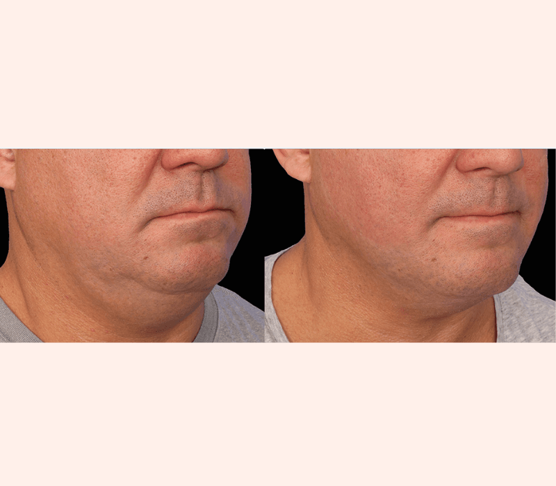 Emface Submentum before and after double chin treatment in Westchester Los Angeles