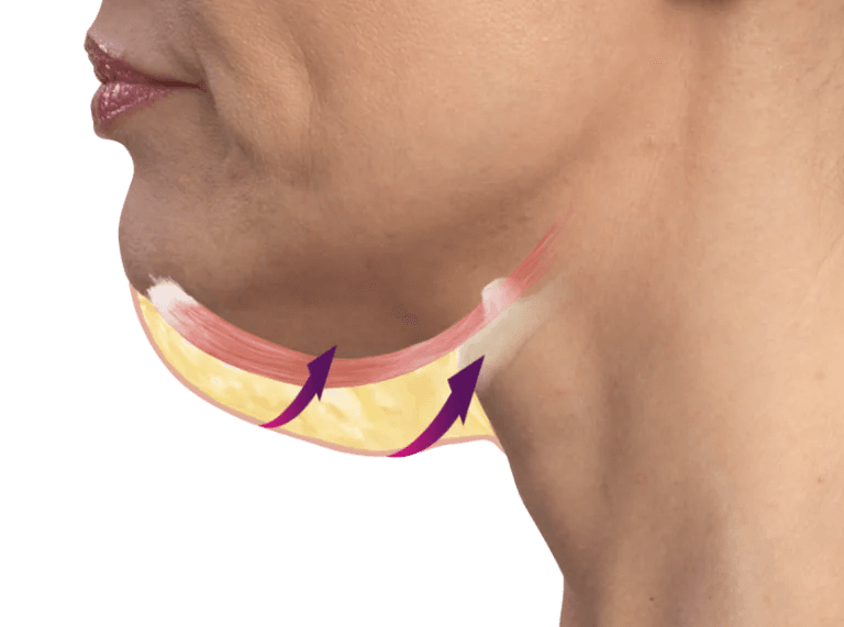 Emface Submentum HIFES muscle stimulation technology in Los Angeles 90045