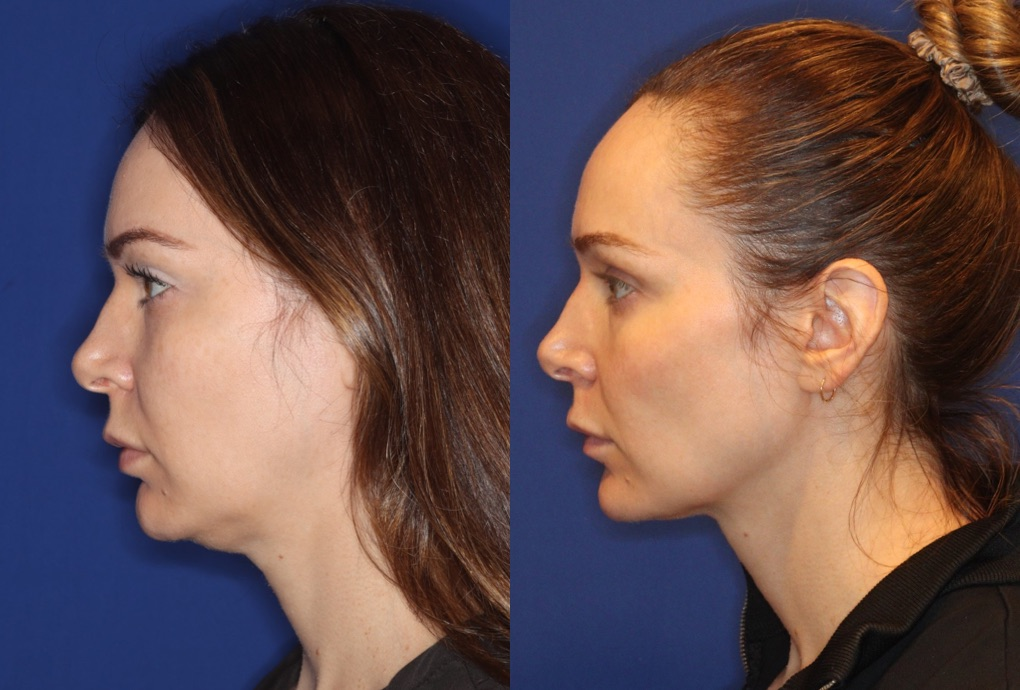 Emface Submentum before and after jawline profile in Los Angeles 90045