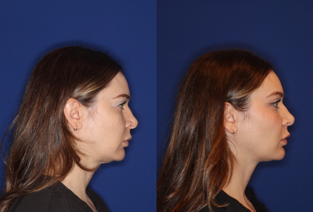 Emface Submentum before and after double chin treatment in Westchester Los Angeles