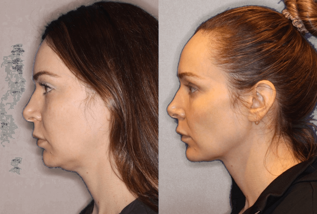 Profile illustrating the submental and double-chin contour treatment zone for EMFACE in Westchester Los Angeles