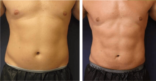 EmsculptNEO before and after abdomen muscle definition at Total Body Aesthetic med spa Los Angeles