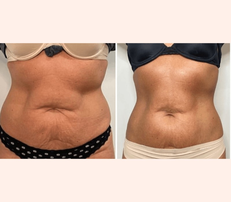 EmsculptNEO before and after stomach results near Marina del Rey Los Angeles