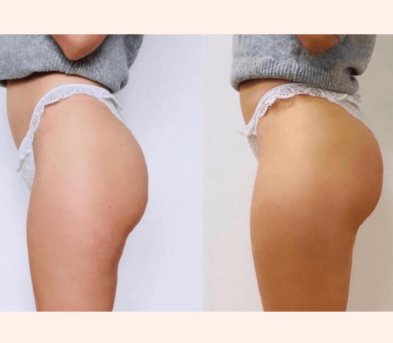 EmsculptNEO before and after glutes results in Westchester Los Angeles