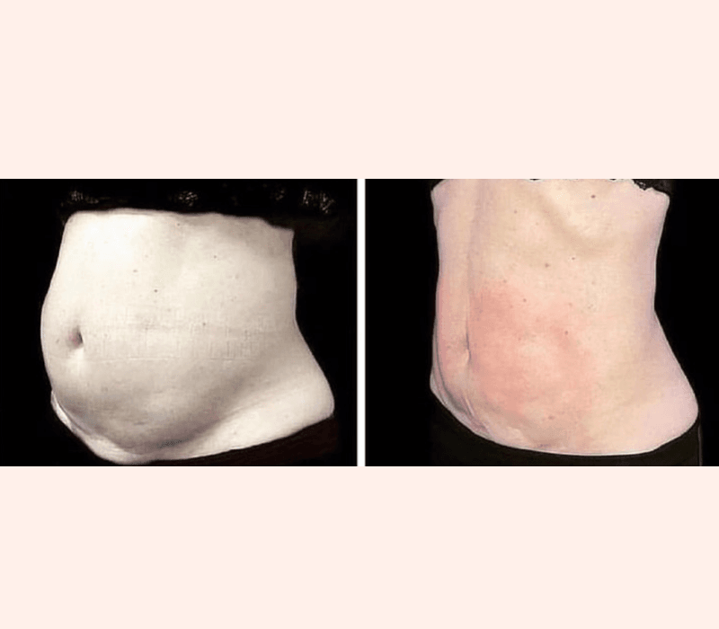 EmsculptNEO before and after core definition near Playa Vista Los Angeles