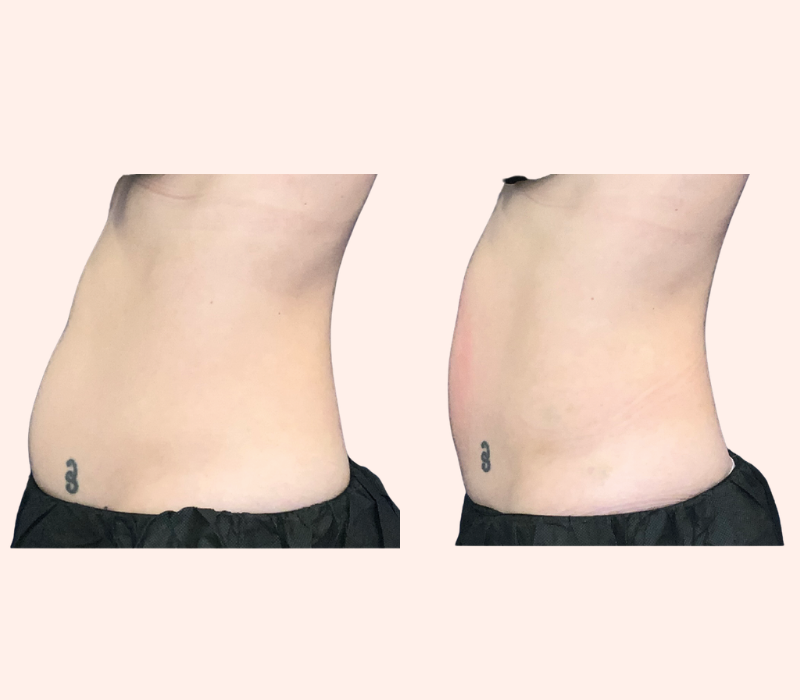 EMSELLA before and after pelvic floor results near Playa Vista Los Angeles