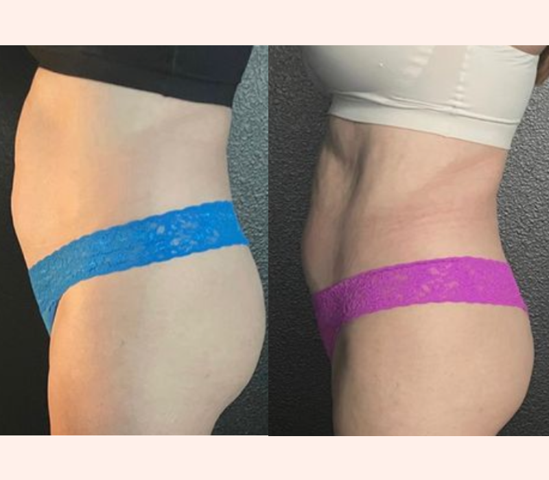 EMSELLA before and after incontinence results in Los Angeles 90045