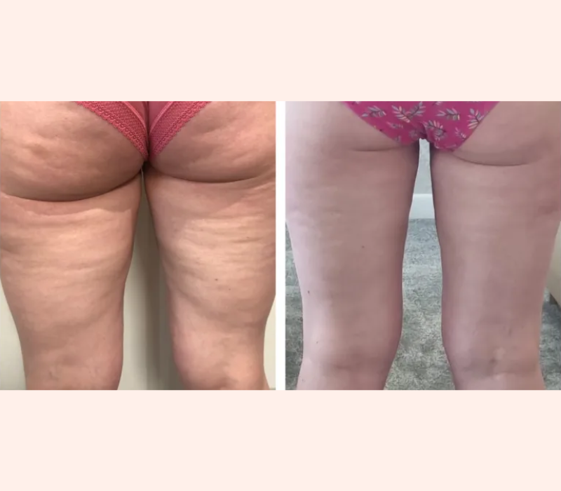 Emtone before and after cellulite results near Playa Vista Los Angeles