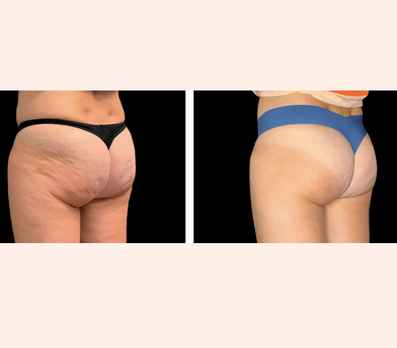 Emtone before and after skin smoothing results in Los Angeles 90045