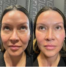 EZ Gel PRF before and after results in Los Angeles 90045