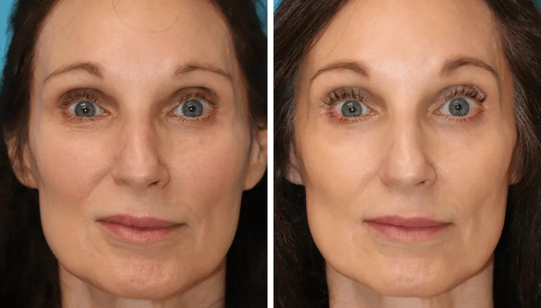 EZ Gel PRF before and after skin results near Marina del Rey Los Angeles