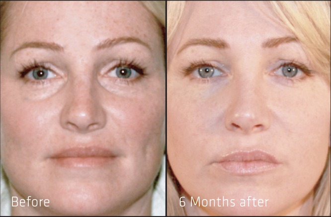 EZ Gel PRF before and after results at 6 months at Total Body Aesthetic med spa Los Angeles