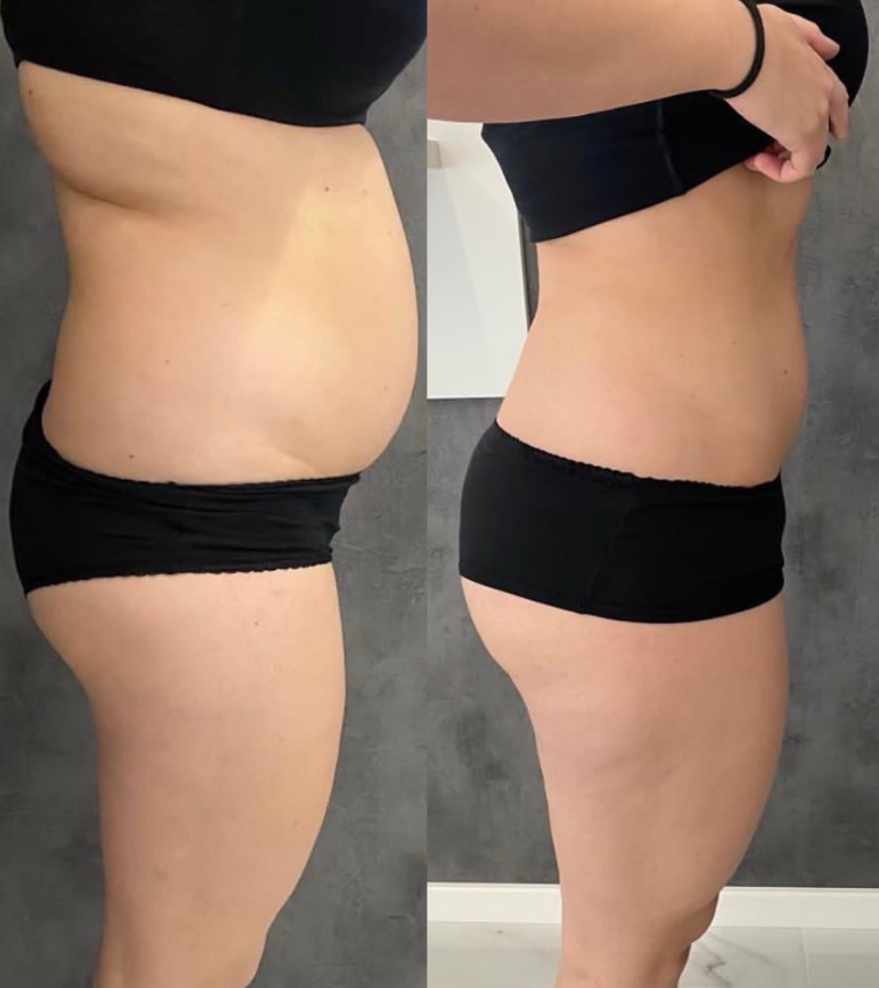 Metabolic Reset Weight Loss Program - Metabolic reset weight loss before and after results at Total Body Aesthetic