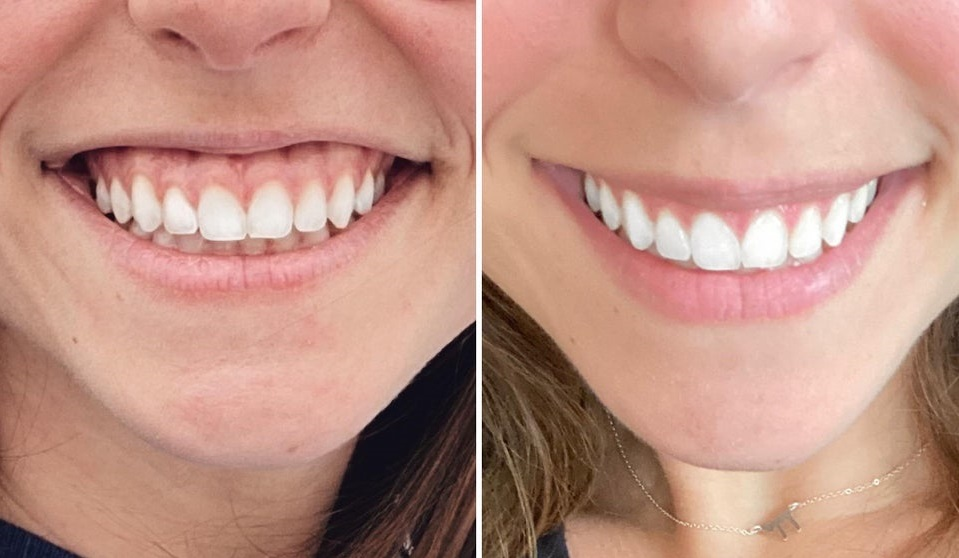 Gummy smile Botox before and after results in Los Angeles 90045