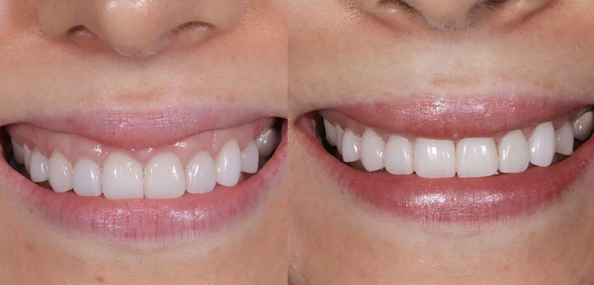 Gummy smile Botox before and after results in Westchester Los Angeles