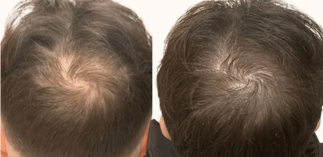 Before and after hair loss treatment results in Westchester Los Angeles