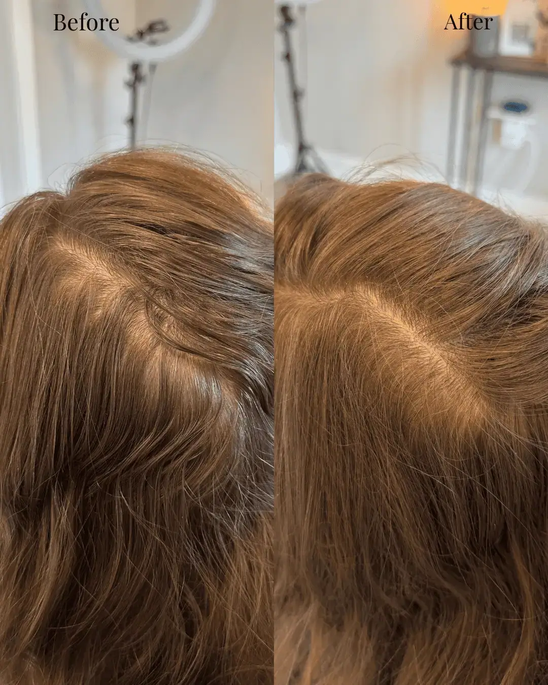 Before and after hair loss treatment results near Playa Vista